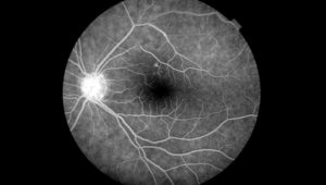 Angiofluoresceinografia