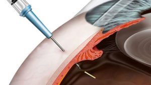 Injeção intravítrea