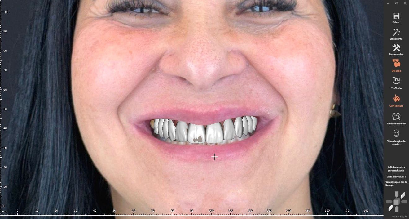 Smile design virtual com rosto da paciente