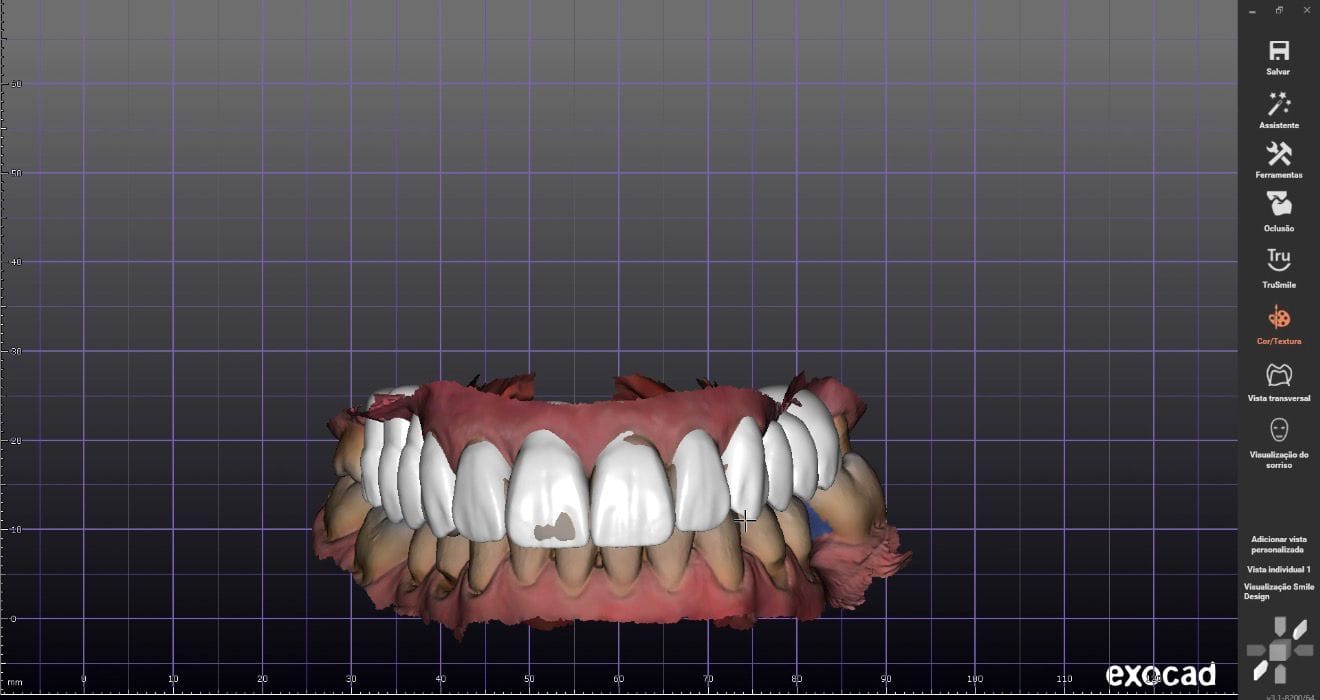 Software Exocad planejamento 3D dental